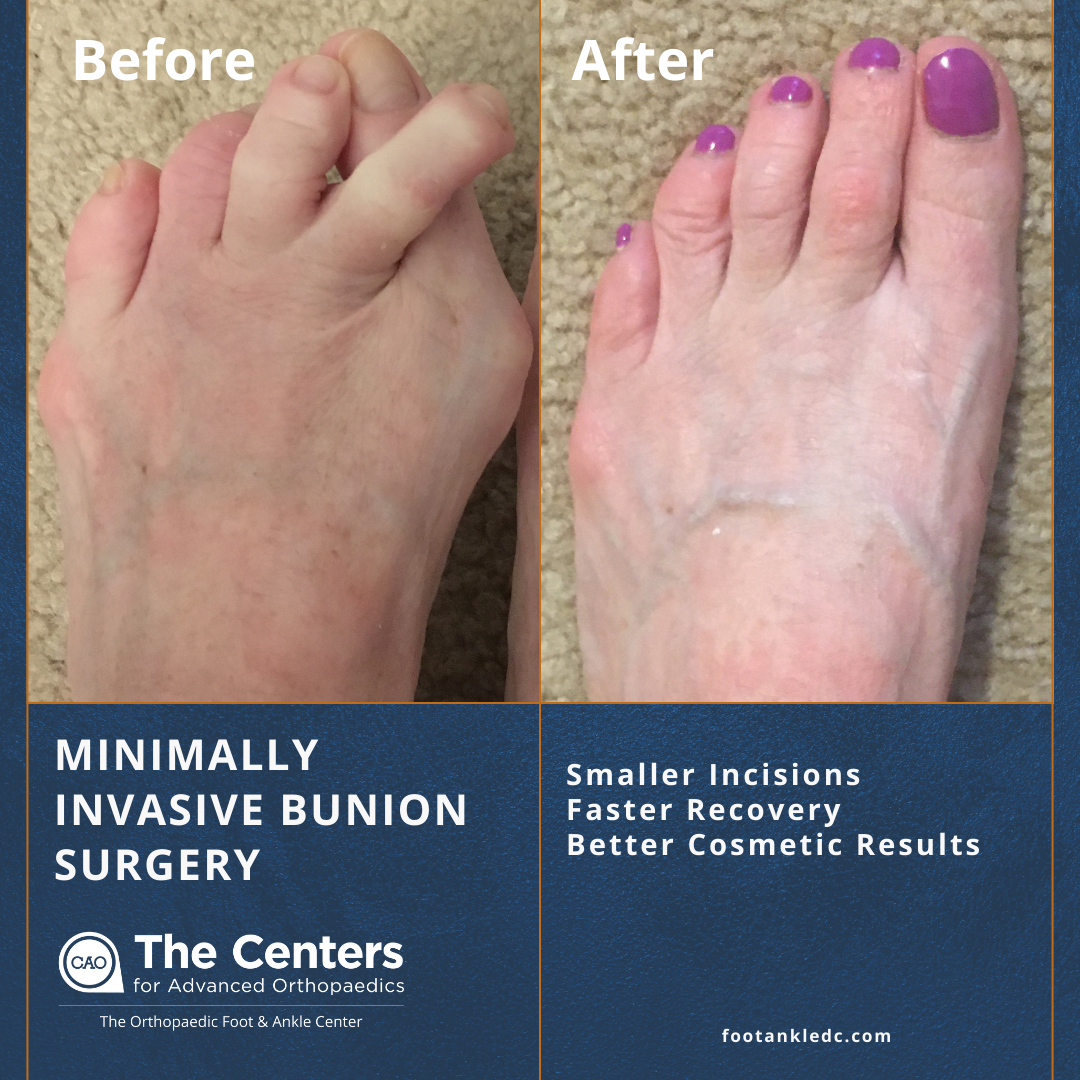 Bunion Surgery