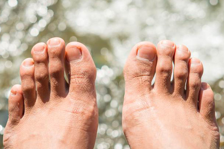 Hammer Toes? How To Fix the Real Cause 