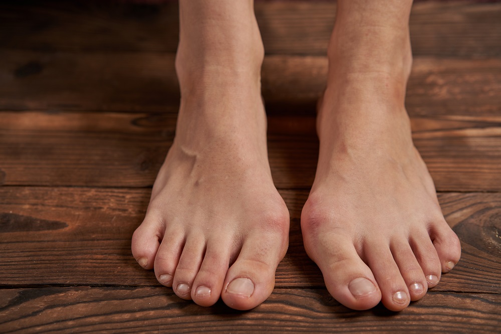 Bunions 101: What You Need to Know About this Common Toe Condition - The  Orthopaedic Foot & Ankle Center