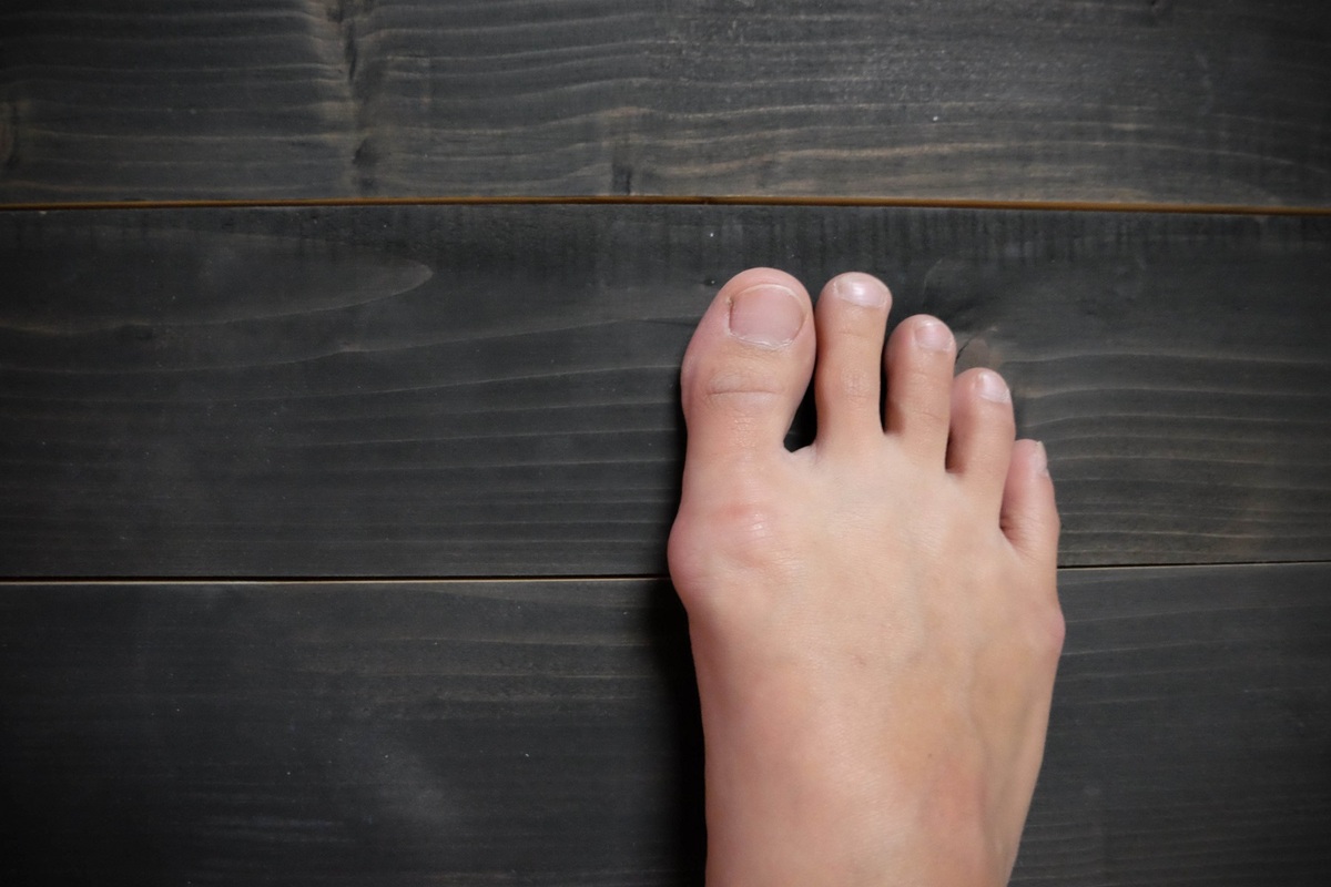 Is It Finally Time To Consider Bunion Surgery?