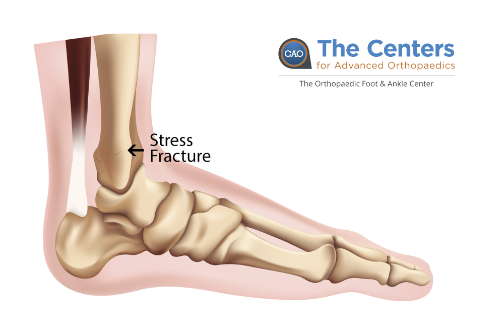 Stressfrakturen