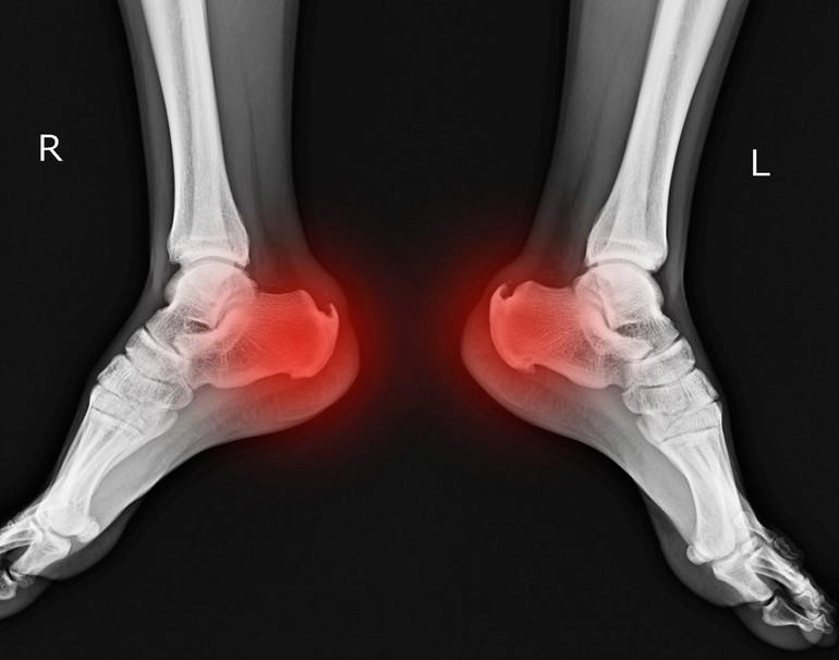 Heel swelling after a fall | The BMJ