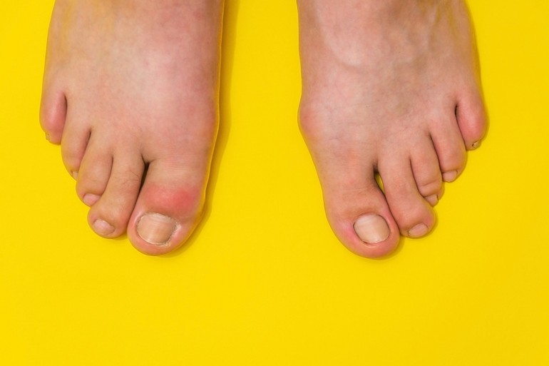 gout toe